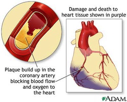 Myocardial infarction (heart attack)