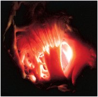 View from the right ventricle showing tendinous cords and papillary muscle