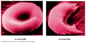 Normal and sickled red blood cells
