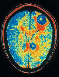 PET scan of the brain showing metabolic activity