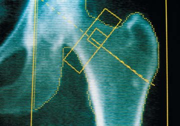 Bone densitometry scan