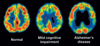 PET scans comparing normal, mild cognitive impairment, and Alzheimer's disease brains