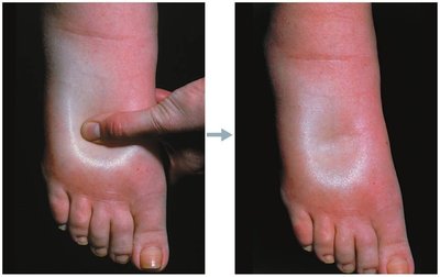 Pitting edema