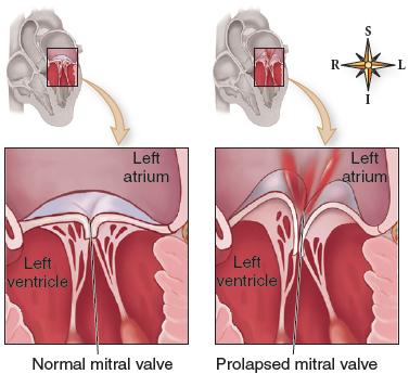 Diagram comparing normal and prolapsed mitral valve