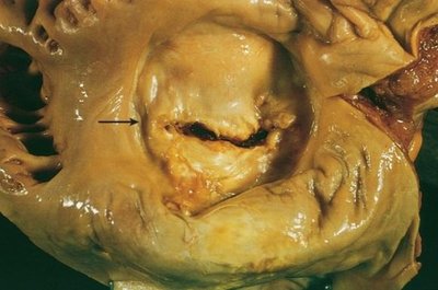 Pathological specimen showing mitral valve stenosis