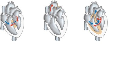 Congenital heart defects: ventricular septal defect, coarctation of the aorta, tetralogy of Fallot