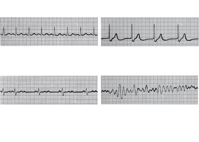 ECG tracings of normal and abnormal rhythms