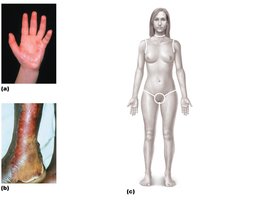 Images showing burn types and rule of nines