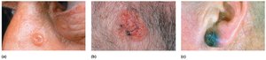 Photographs of skin cancers: basal cell carcinoma, squamous cell carcinoma, melanoma