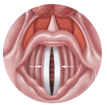 Open vocal cords (abduction)