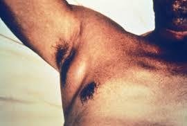 Swollen lymph node in axilla