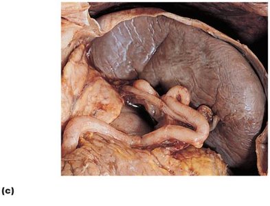 Spleen in abdominal cavity