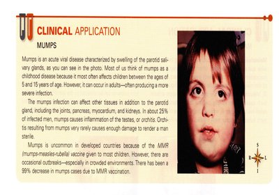 Mumps clinical application