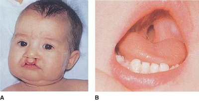 Cleft lip and palate