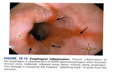 Esophageal inflammation in GERD