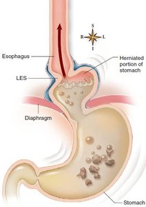 Hiatal hernia diagram