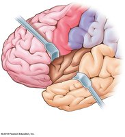 Insula exposed by retractors