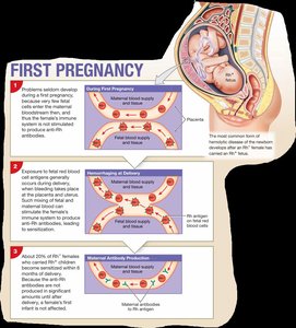 Second pregnancy and Rh incompatibility