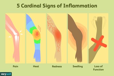 Diagram: 5 cardinal signs of inflammation