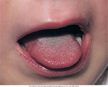 Strawberry tongue in scarlet fever