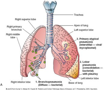 Types and locations of pneumonia in the lung