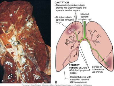 Gross and schematic view of tuberculosis cavitation and spread