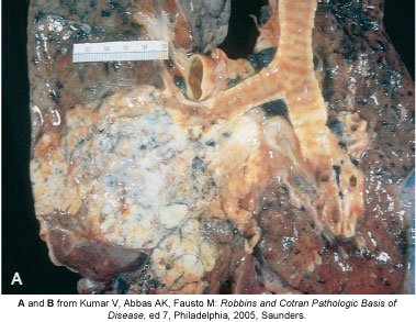 Gross pathology of lung cancer