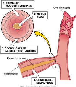 Pathophysiology of asthma: airway inflammation and obstruction