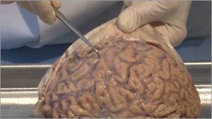 Diagram of dura mater partitions and sinuses