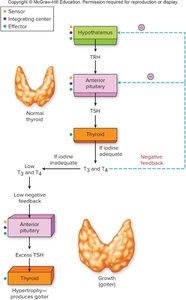 Goiter due to iodine deficiency