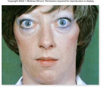 Graves' disease goiter