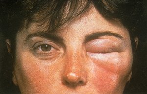 Allergic skin reaction