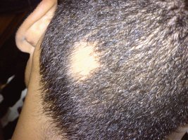 Alopecia areata: patchy hair loss