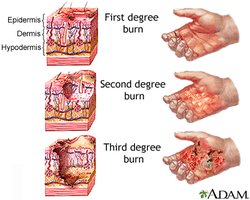 Degrees of burns and affected skin layers