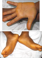 Carotenemia: yellow-orange pigmentation of skin