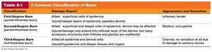 Table showing classification of burns