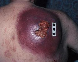 Advanced melanoma on the back