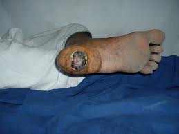 Advanced decubitus ulcer on the foot