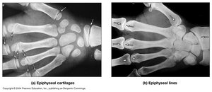 Epiphyseal cartilage and epiphyseal lines in x-ray