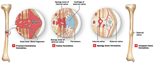 Steps in fracture repair