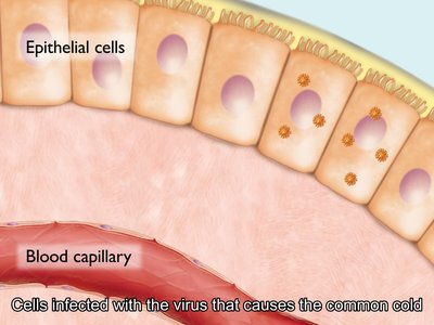 Epithelial cells infected with the virus that causes the common cold