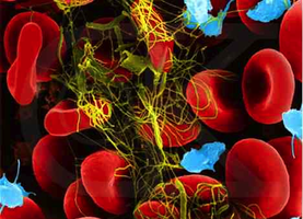 Blood clot showing fibrin mesh trapping erythrocytes and platelets