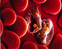 Microscopic view of a ruptured erythrocyte among healthy red blood cells