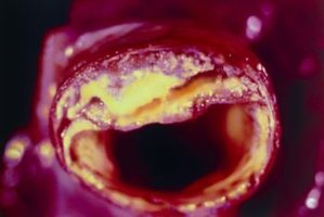 Atherosclerotic plaque in artery