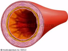 Cross-section of artery with atherosclerosis