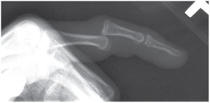 X-ray of joint dislocation