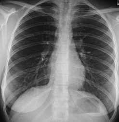 X-ray of the chest
