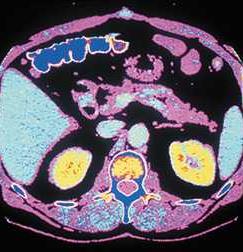 CT scan of the abdomen