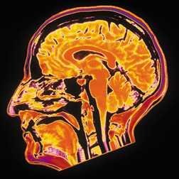 MRI of the head