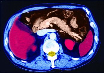 Transverse section MRI scan